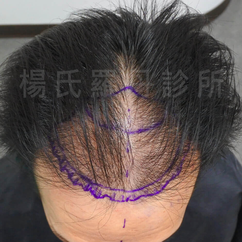 植髮 禿頭 ARTAS  植髮機器